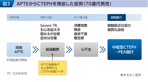 図3 APTEからCTEPHを発症した症例（70歳代男性）