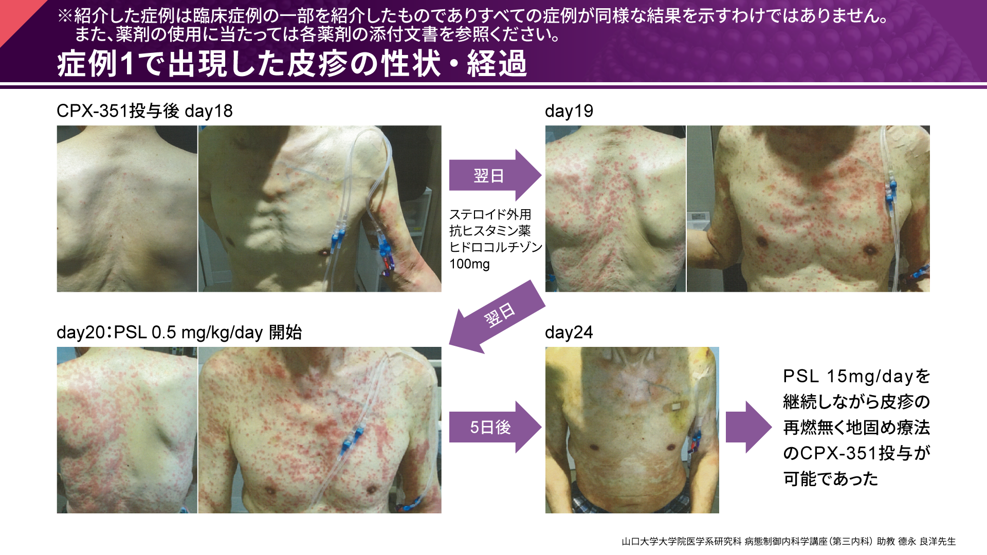 高リスクAMLについて語る ー高リスクAML治療のClinical Questionー